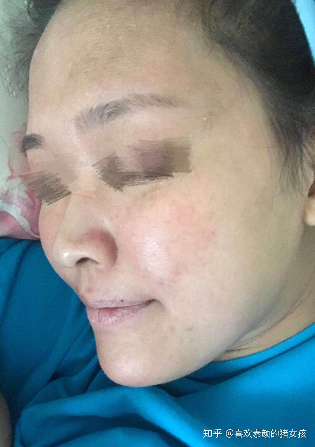 激素依赖性皮炎通常如何治疗?