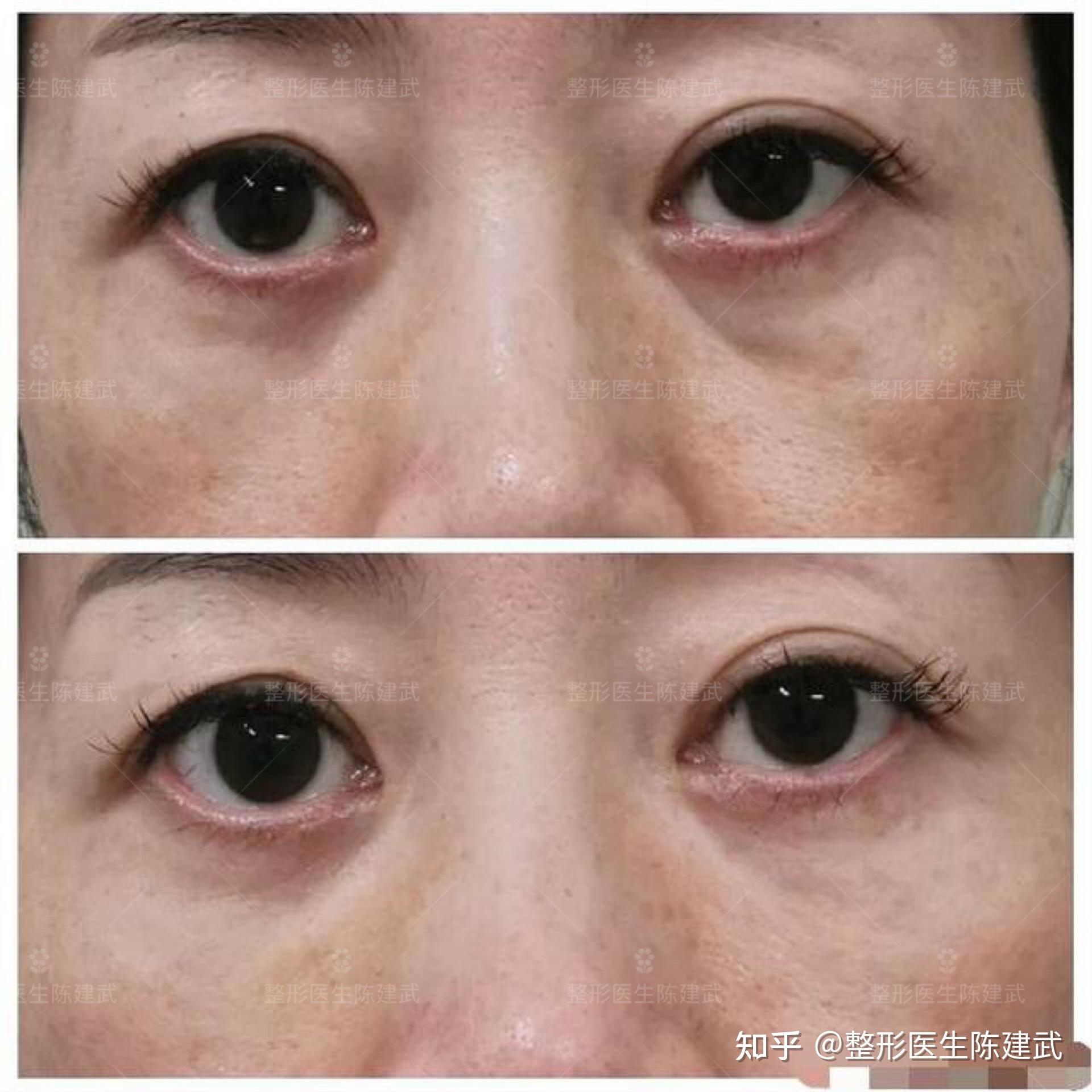 贵州贵阳双眼皮修复+内路眼袋手术后即刻对比照片 - 知乎