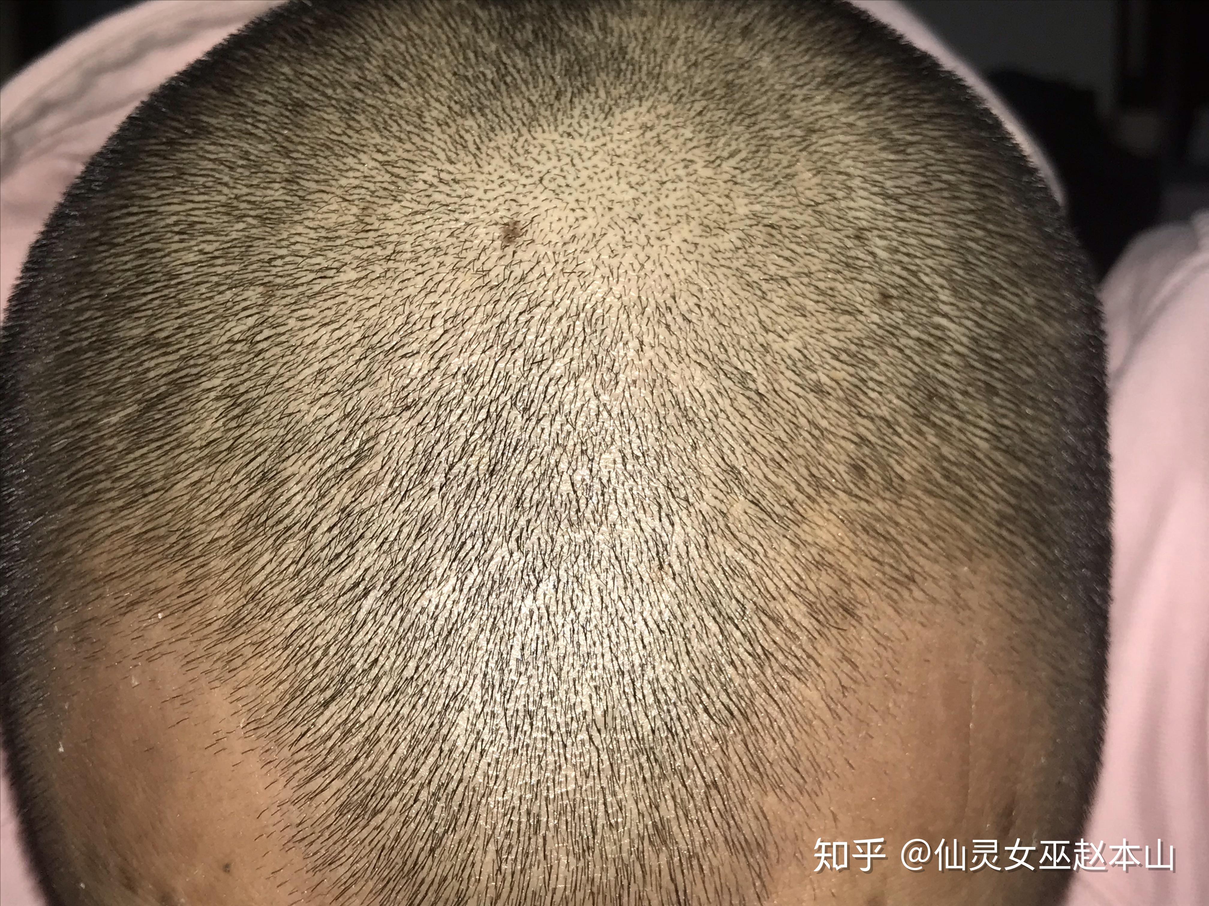 微针滚轮77米诺地尔失败改服用非那更新到头发长出来为止