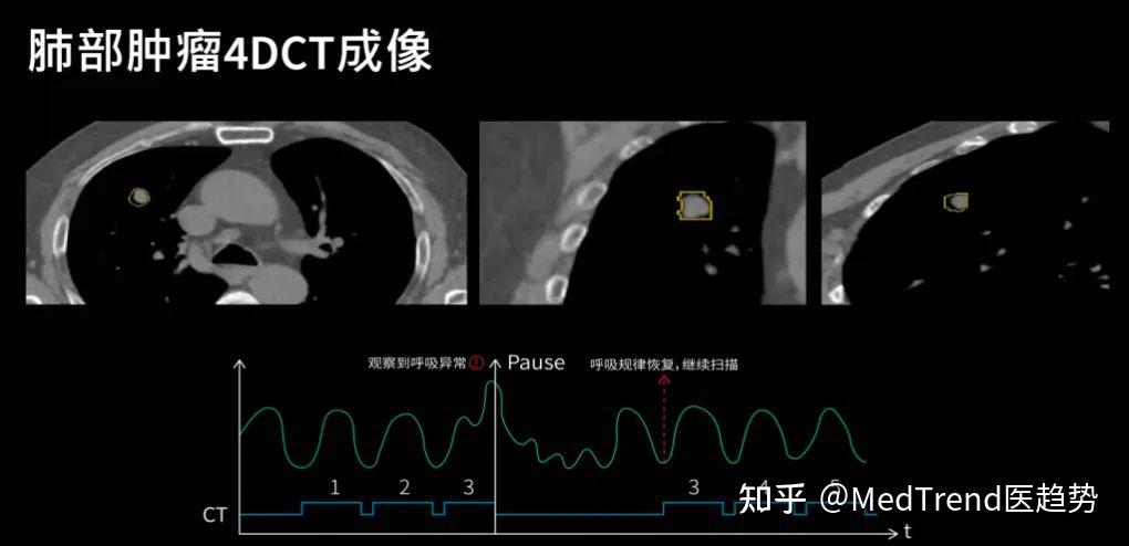 效率精准双引擎，GE医疗重塑放疗影像定位新格局 - 知乎