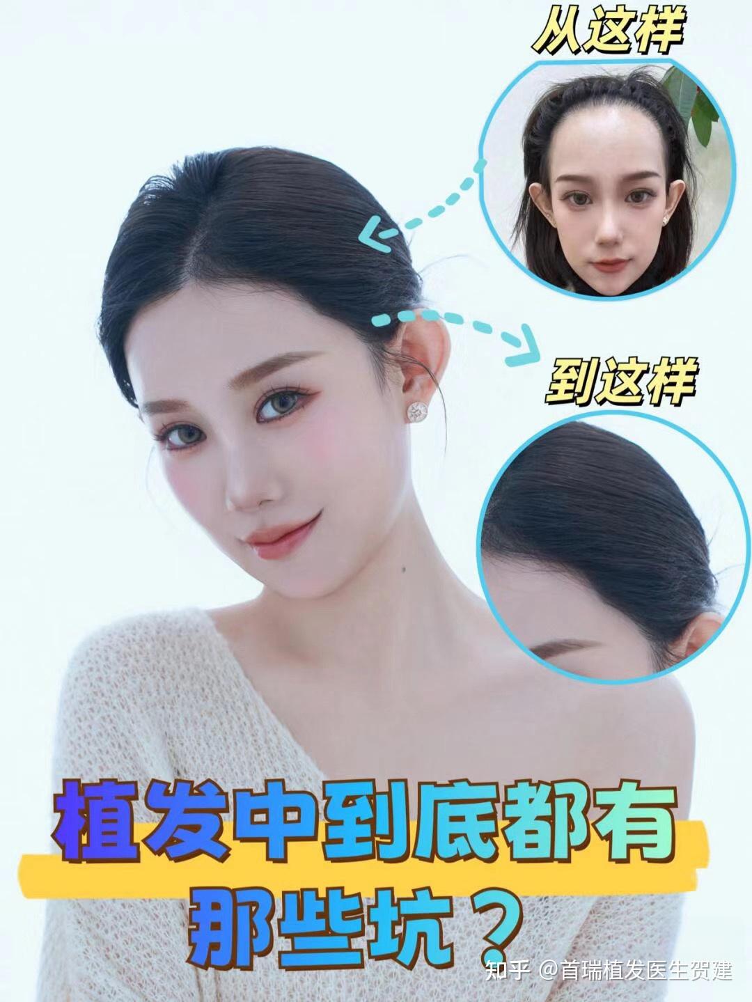 植发逆袭后,来数数我踩过的坑! - 知乎