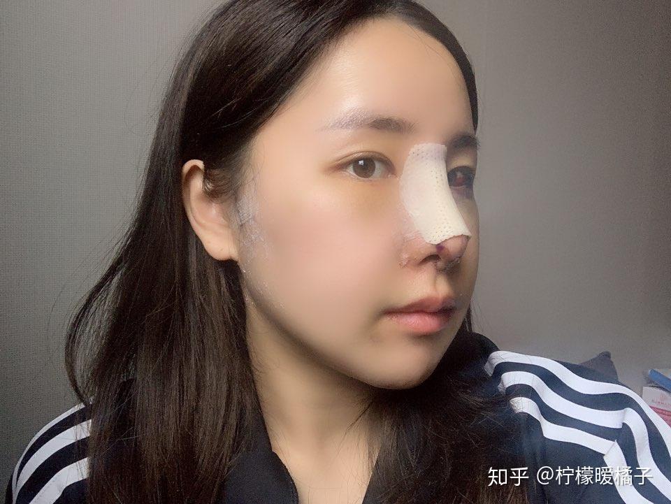 异体骨隆鼻会排异吗_做了异体骨隆鼻心得_异体骨隆鼻