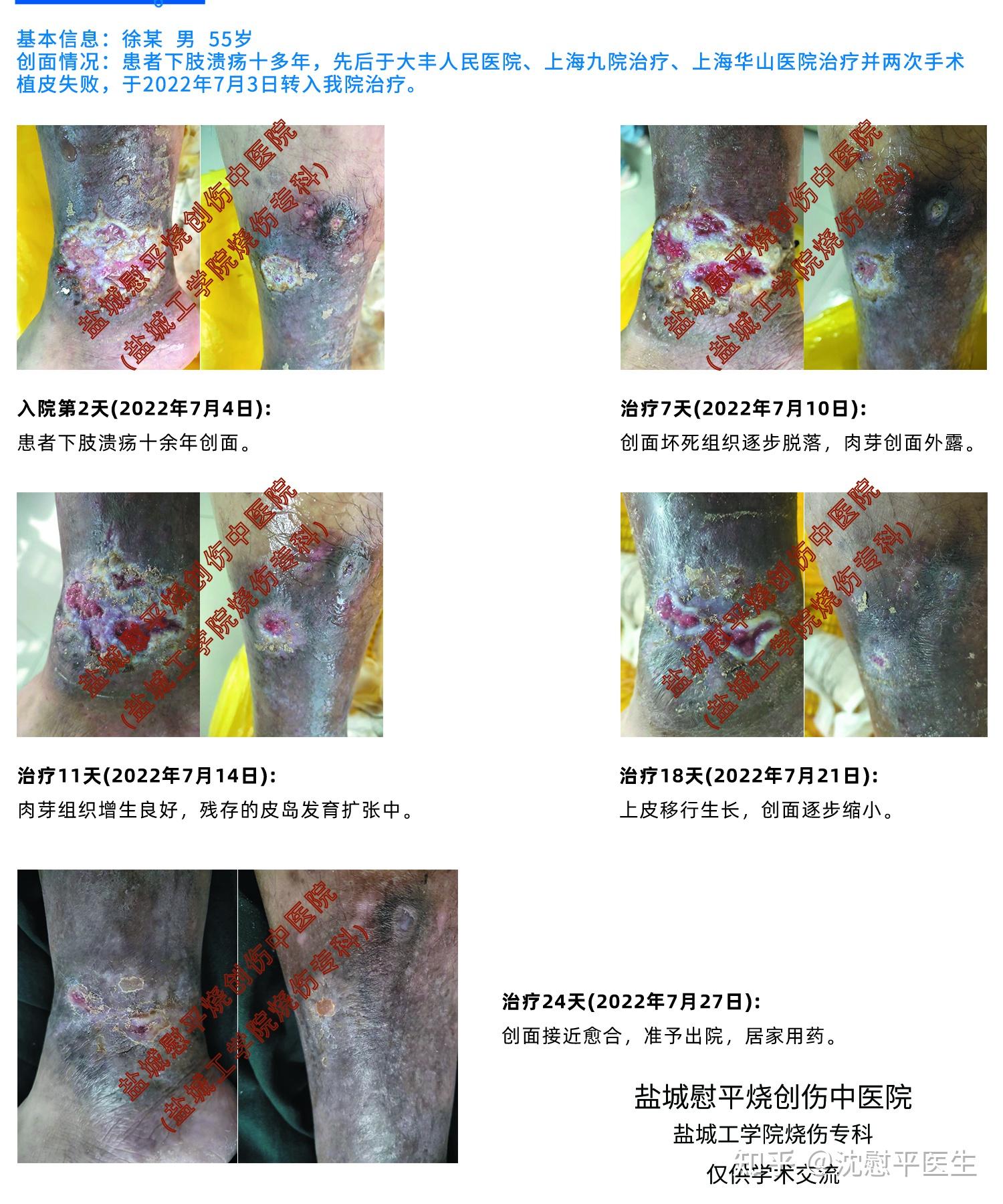 刺青切除+全層植皮術、術後2週 | TETSU形成・美容クリニック 田中哲一郎のブログ