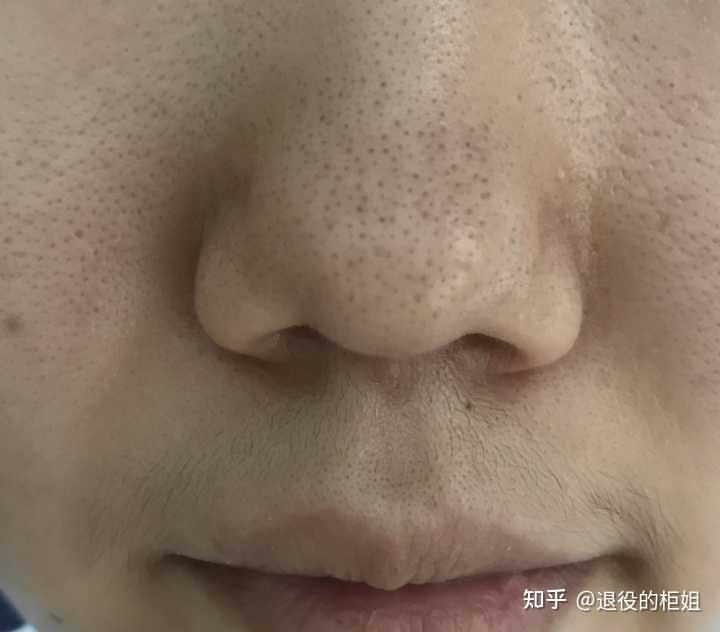 如何去除脂质微丝运动医美