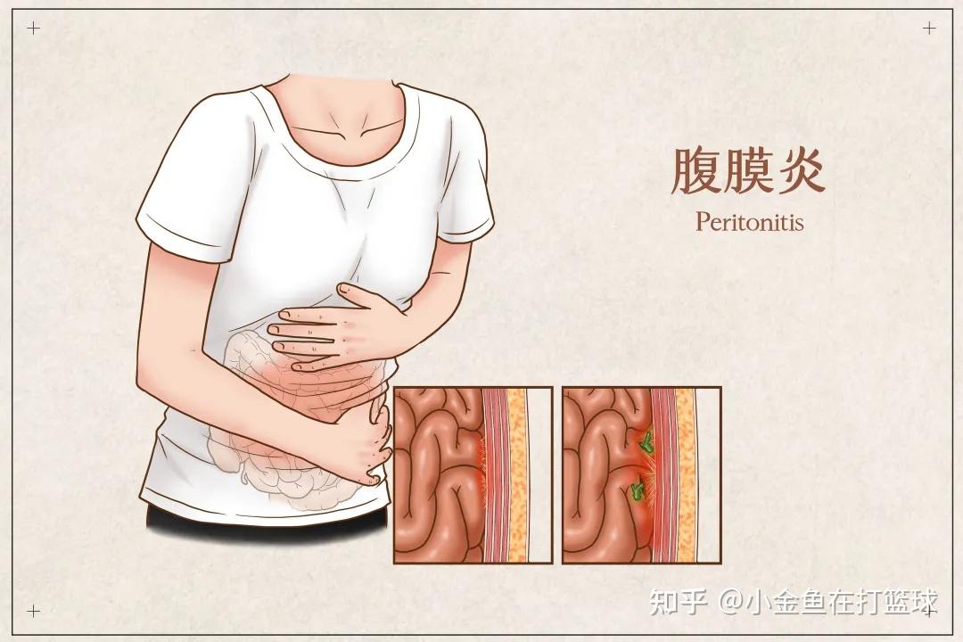 腹膜透析的患者怎么预防腹膜炎的发生? 