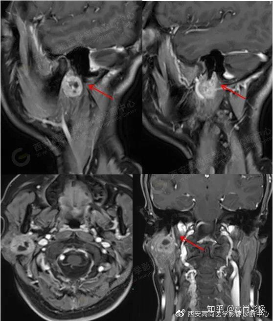 西安高尚医学影像病例腮腺区面神经鞘瘤