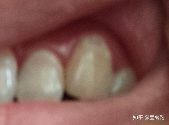牙齿矿化/钙化小记 - 知乎
