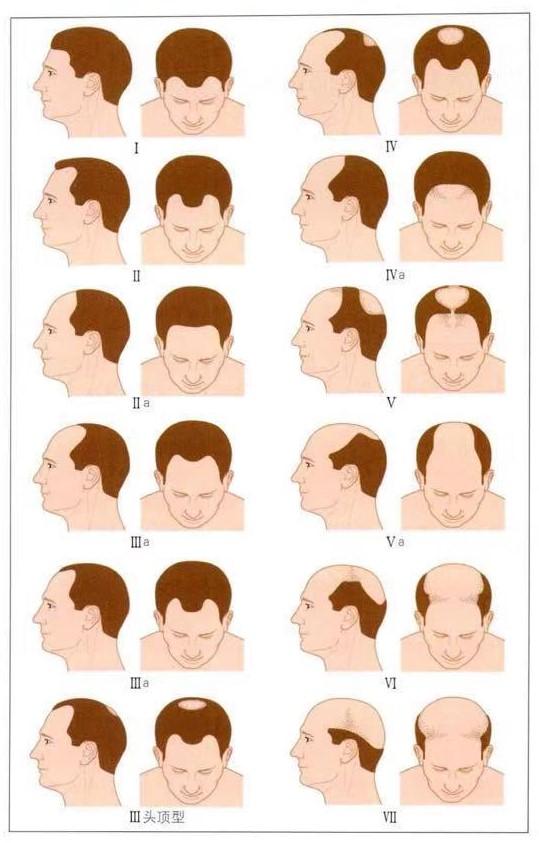 男性型脱发 Mphl 和女性型脱发 Fphl 临床表现 知乎