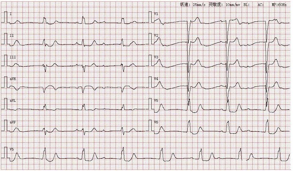 心电图 图谱分析 详细解读【中】(知识点总结/重点