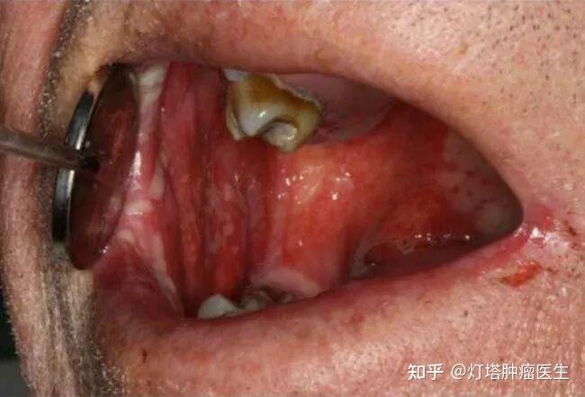 口服化疗药导致口腔黏膜炎怎么办