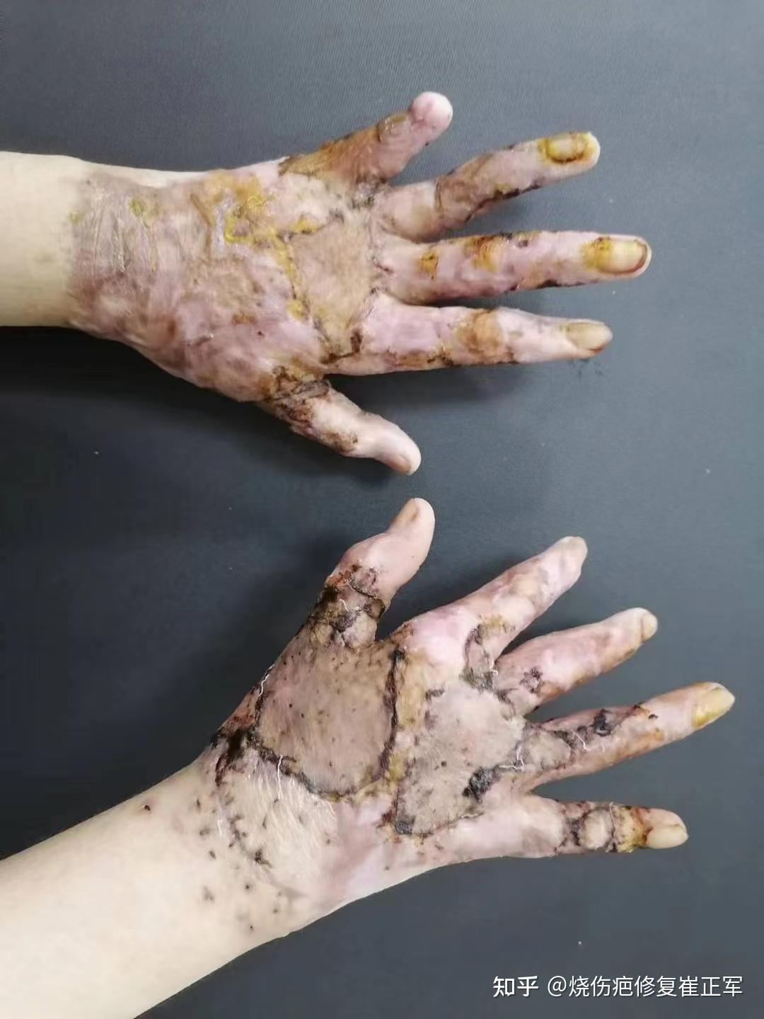 不会导致疤痕增生挛缩,并且牵引可以有效地避免植皮以后的皮肤回缩