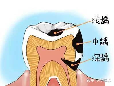 治疗蛀牙需要多少钱 知乎