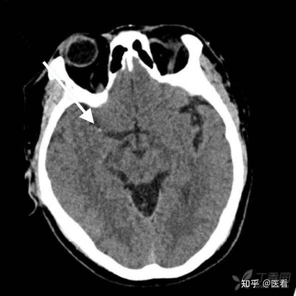 脑梗死影像学表现图片