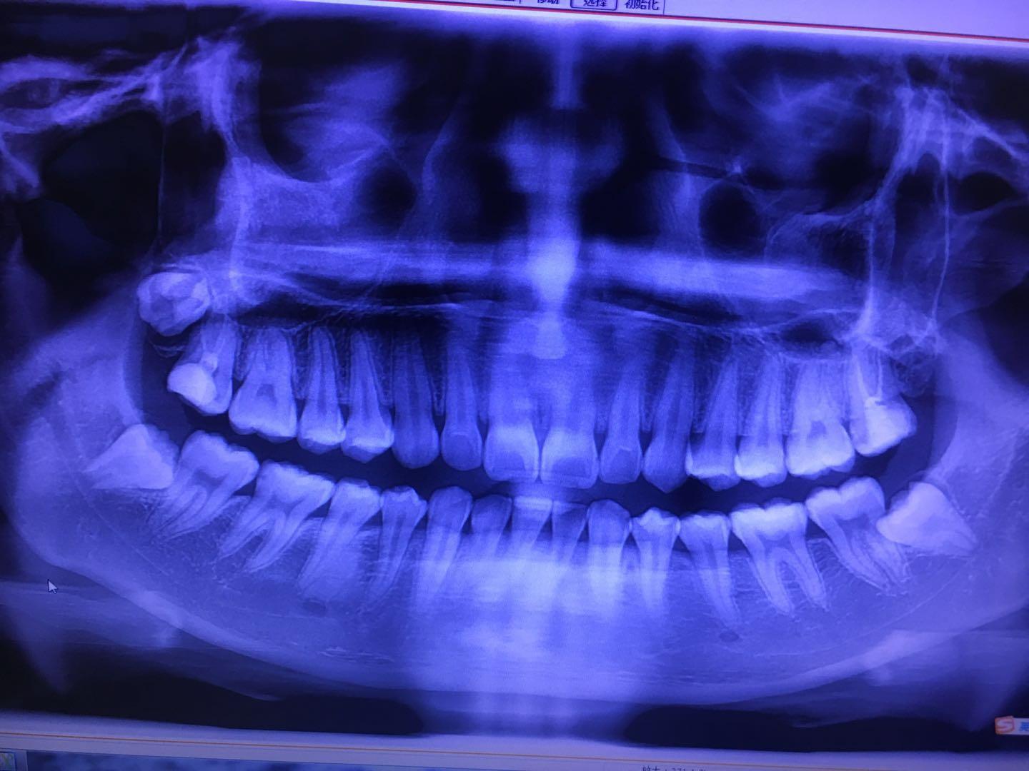 拔牙价格多少才合理?