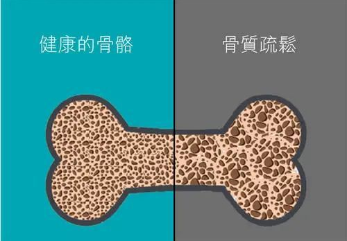 骨质疏松多长时间能补上来 v2-db2b8a04e918c2dbc59d324fa492ead9_1440w.jpg?source=172ae18b
