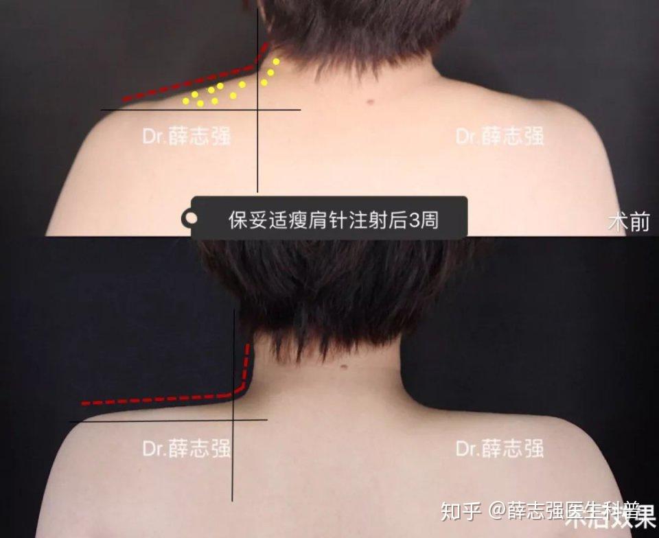 下颌线注射提升_下颌线提升针剂_注射下颚线提升多久有效果