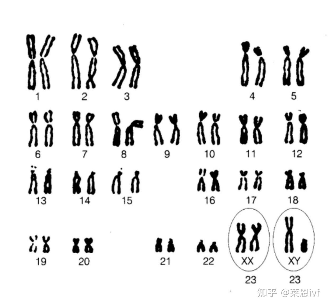 48,XXYY型综合征_染色体