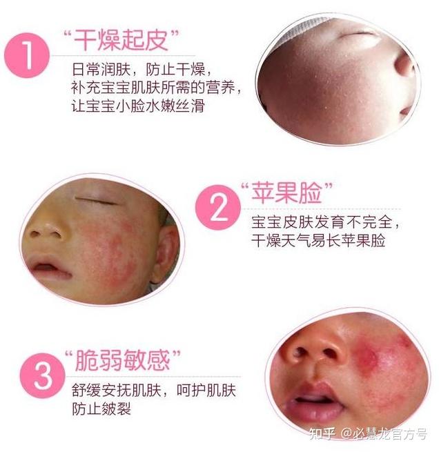 冬日 “小糙皮” 自救指南:养出宝宝水嫩肌,远离干痒红敏 - 知乎