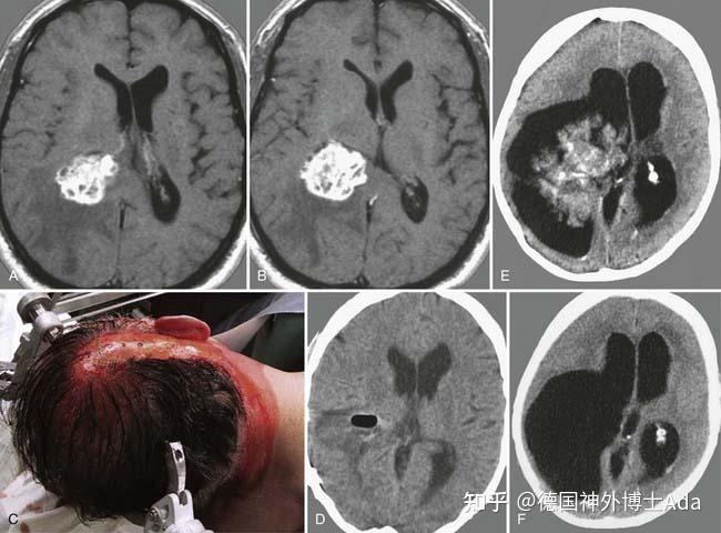 疑难脉络丛乳头状瘤解读及案例一则分析