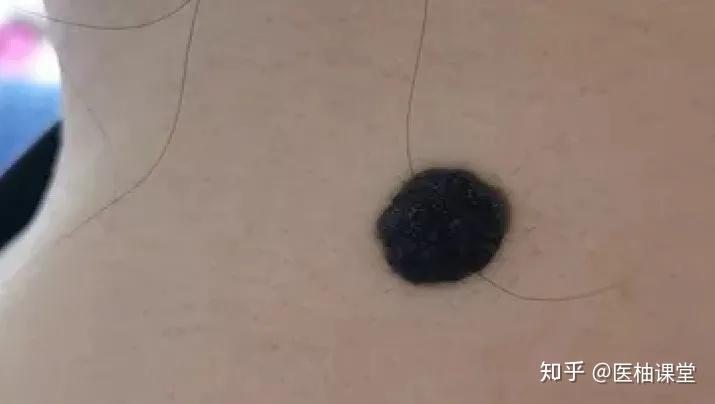 黑痣癌变， 从发病到去世不到两个月！这些痣千万要小心！ - 知乎