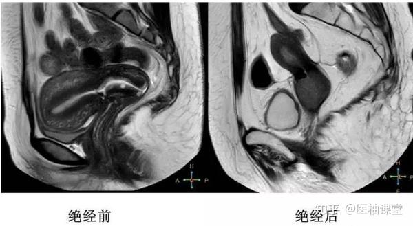 推荐收藏!细说子宫解剖,内附MRI解剖图谱 - 知乎