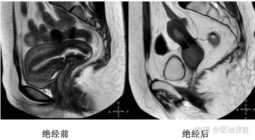 推荐收藏!细说子宫解剖,内附MRI解剖图谱 - 知乎