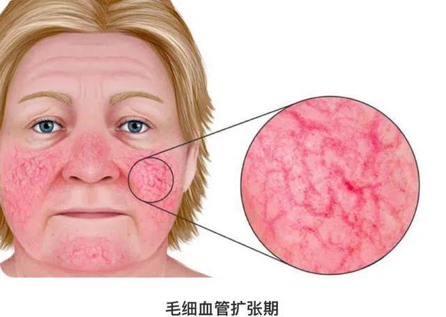 药物光电玫瑰痤疮到底该怎么治