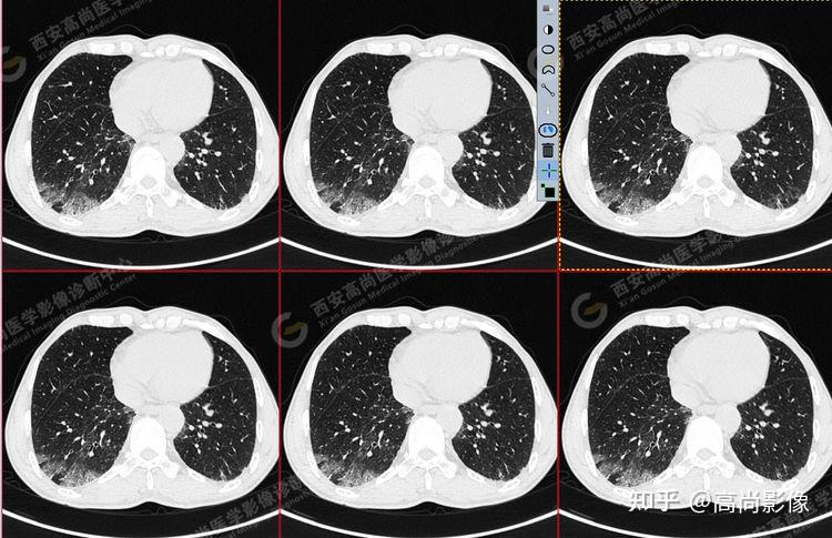 pet/ct病例—肺粘液腺癌,历经3年余终确诊【西安高尚医学影像诊断中心