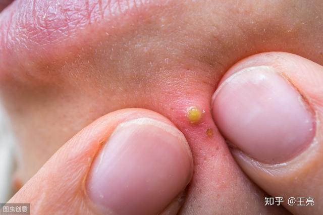 丘疹,大多数呈黑头粉刺样,周围皮肤色红,用手挤压较易挤出黄白色脂栓