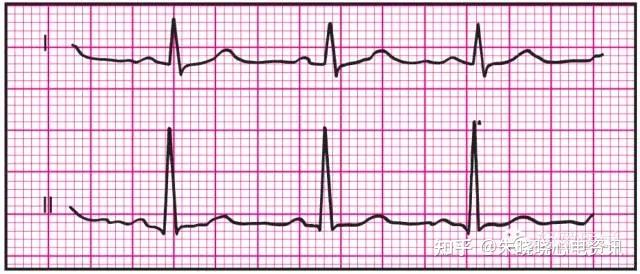 心電基礎ii常見心電圖圖譜解析參考
