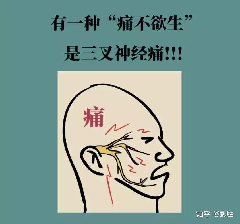 三叉神经痛患者吃什么药效果好