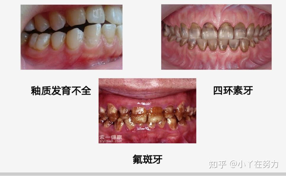 考点知识→牙体缺损