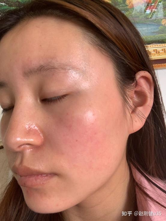 怎么判断自己是不是敏感肌