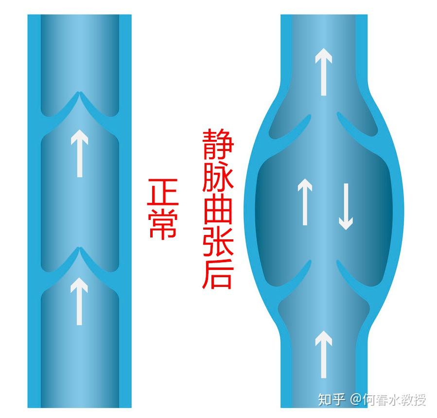 静脉瓣示意图图片