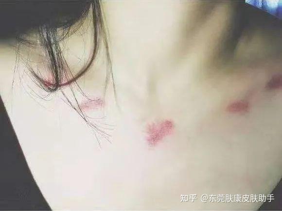 快速消除吻痕的方法你知道吗？ - 知乎