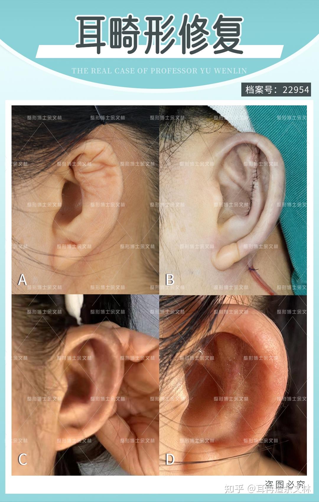 耳朵萎缩图片图片