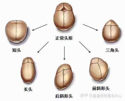 婴儿早期头颅发生变形呈现的外观形态,骨骼形态及可能造成这种现象的