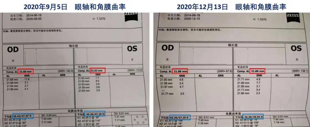 3毫米;一旦近視基因激活,每年的眼軸增幅超過0.4毫米.