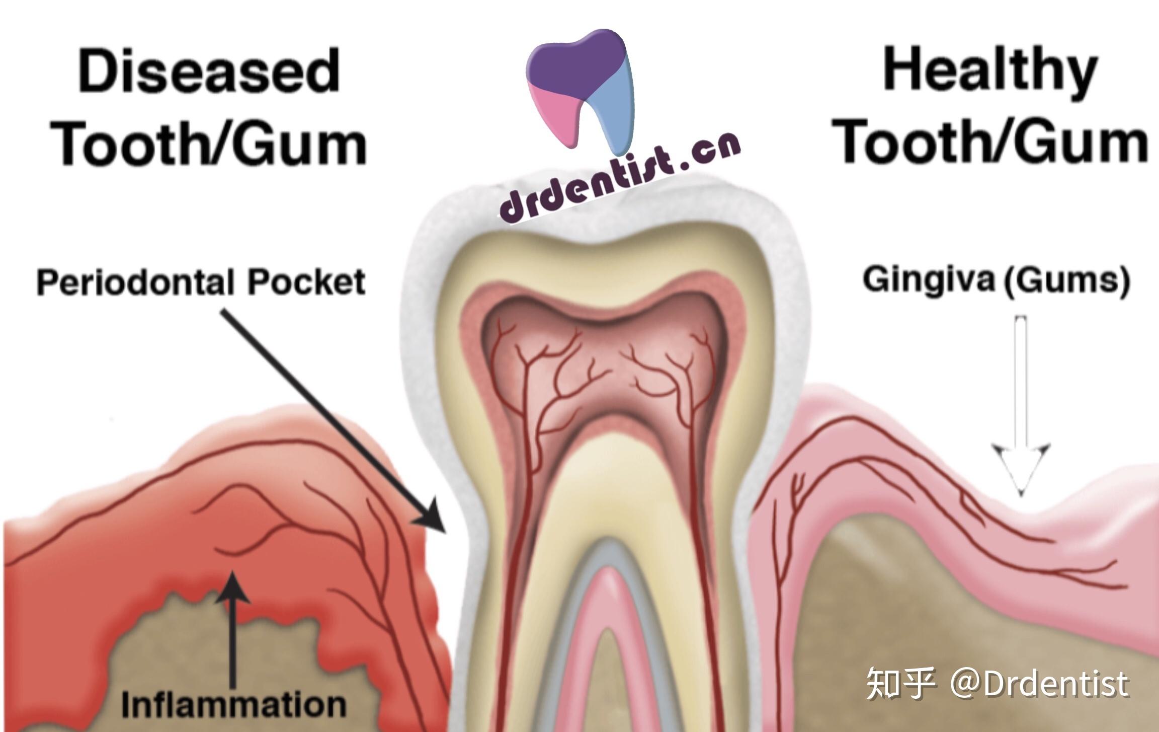 牙龈分解图图片