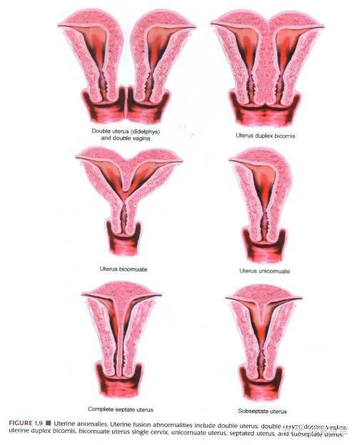 纵隔子宫是子宫形态正常,但子宫内有一个纵隔,可分为完全性纵隔子宫及