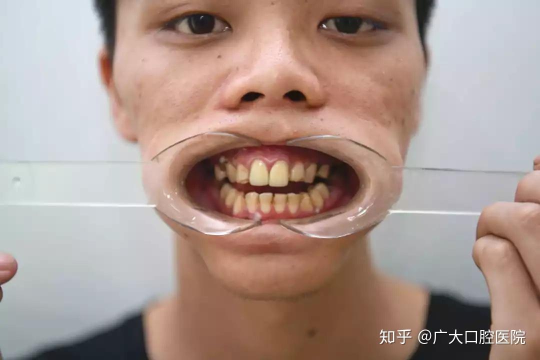 睡觉嘴合不上,侧脸拍照丑,牙齿不整齐…这些问题他怎样解决?