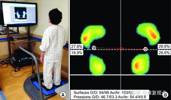 步态分析，详解人类步态和异常步态 - 知乎