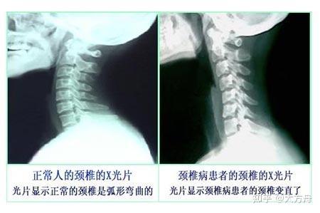 21年 枕头推荐 详细攻略 颈椎病如何挑选枕头乳胶枕 记忆枕 羽绒枕 决明子枕如何挑选最适合自己的枕头 知乎