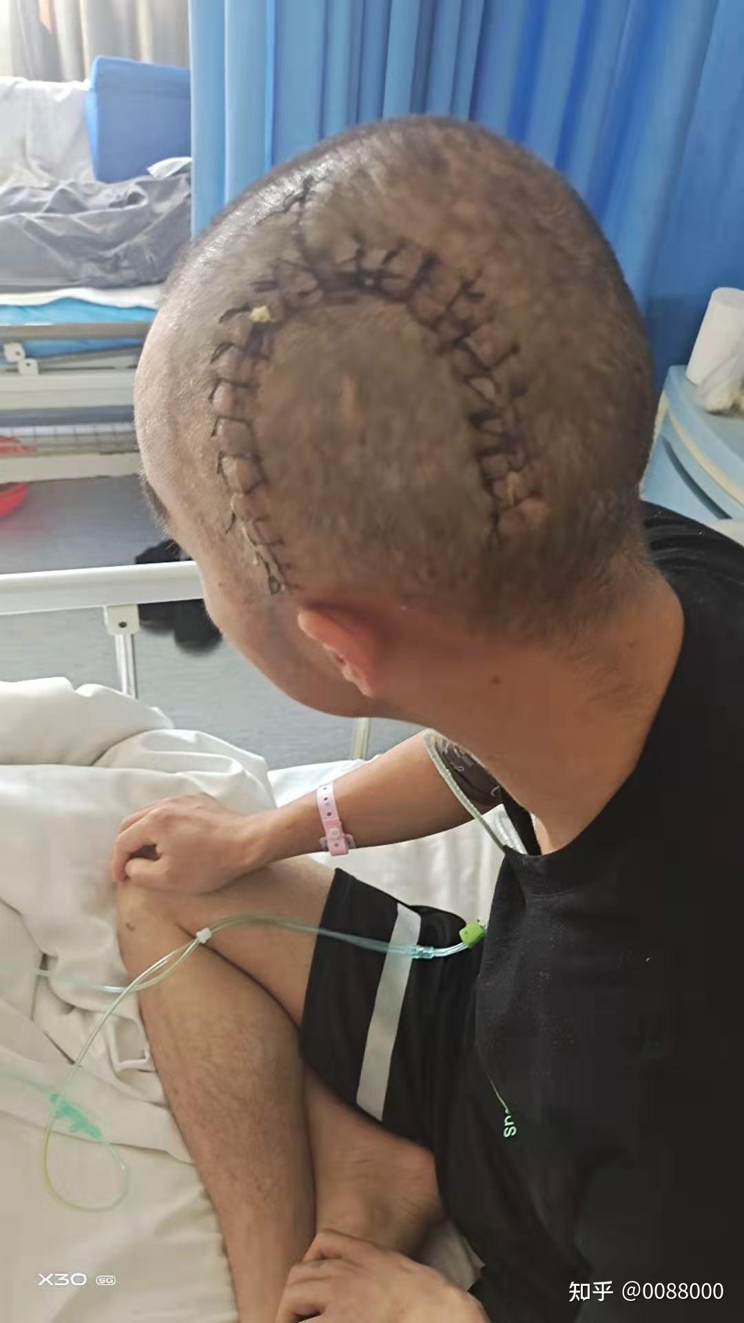 32岁经历了死亡外科大型手术开颅手术