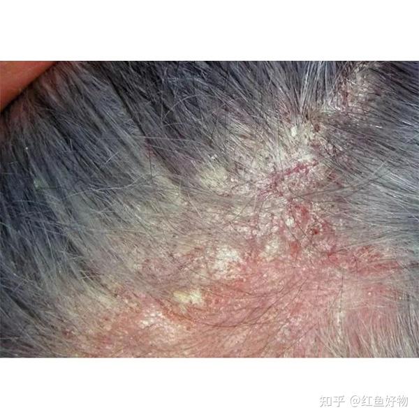 头皮总是痒用什么洗发水?去屑修复洗发水推荐 - 知乎