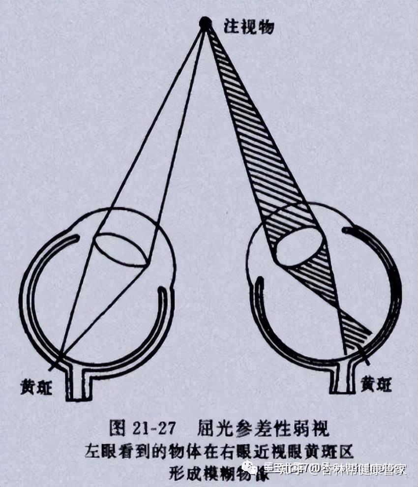 家长必读:弱视,到底是怎么回事? - 知乎