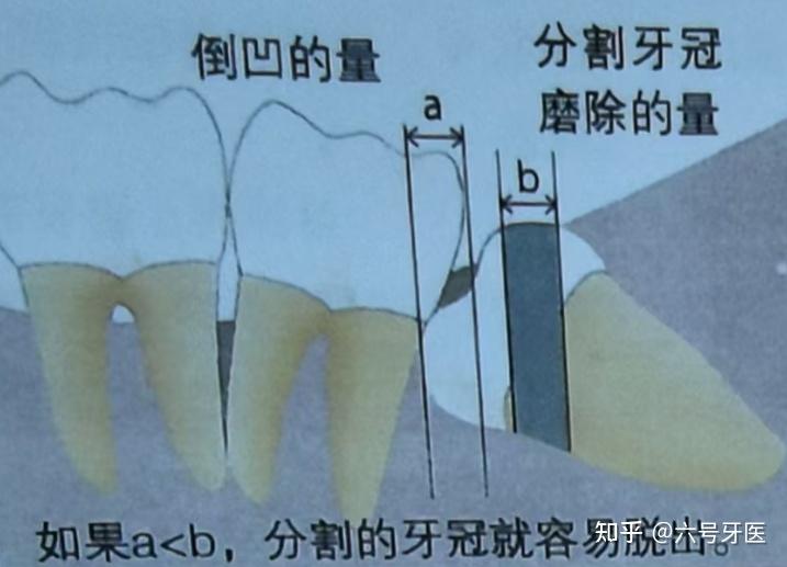 口腔拔牙技巧总篇 - 知乎