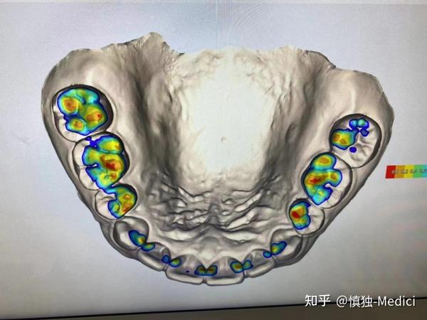上颌门牙的缝隙在片切后容易反弹的原因、解决措施 - 知乎