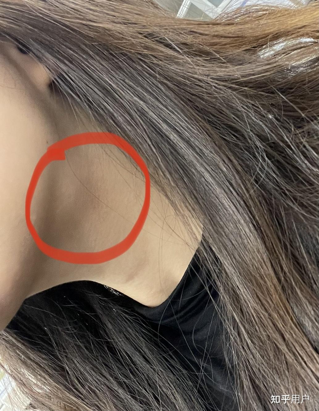 怎么消除催吐后的脸肿唾液腺肿大