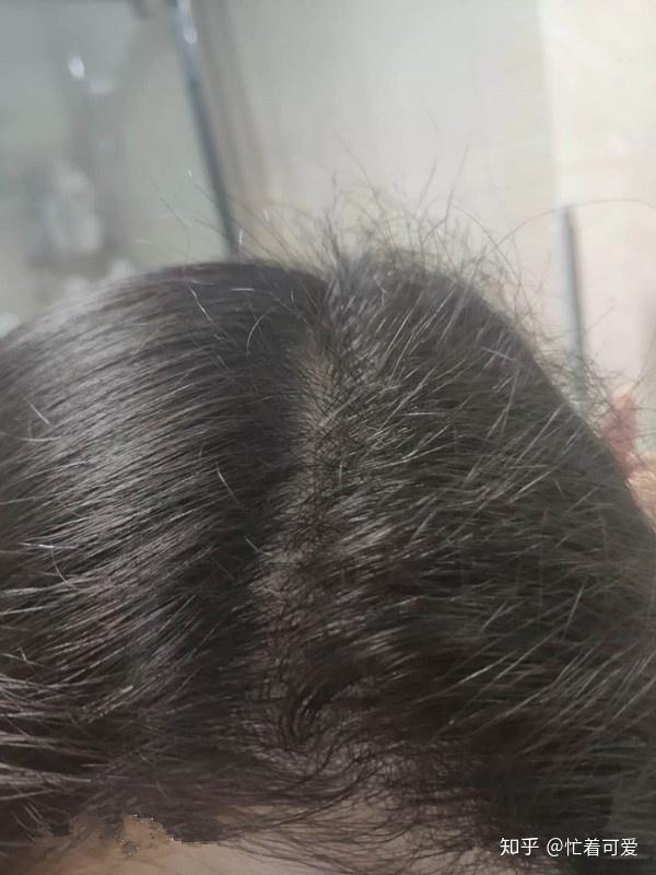 有什么好的方子可以生发？